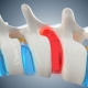 lower back bulging disc symptoms