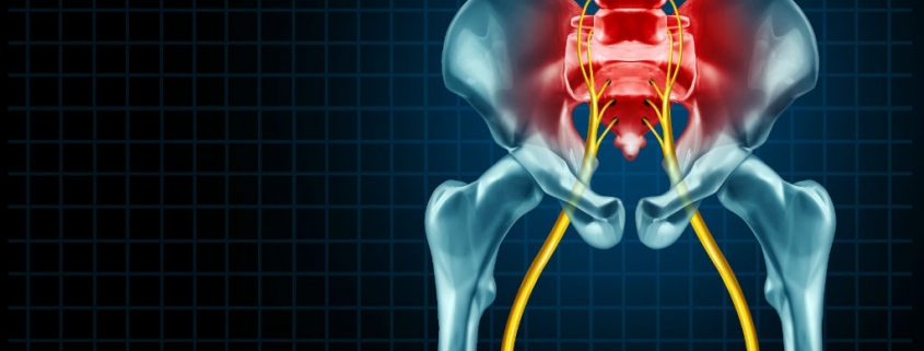 sciatica symptoms