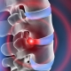 bulging disc treatment